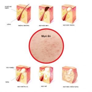 trị mụn tuổi dậy thì