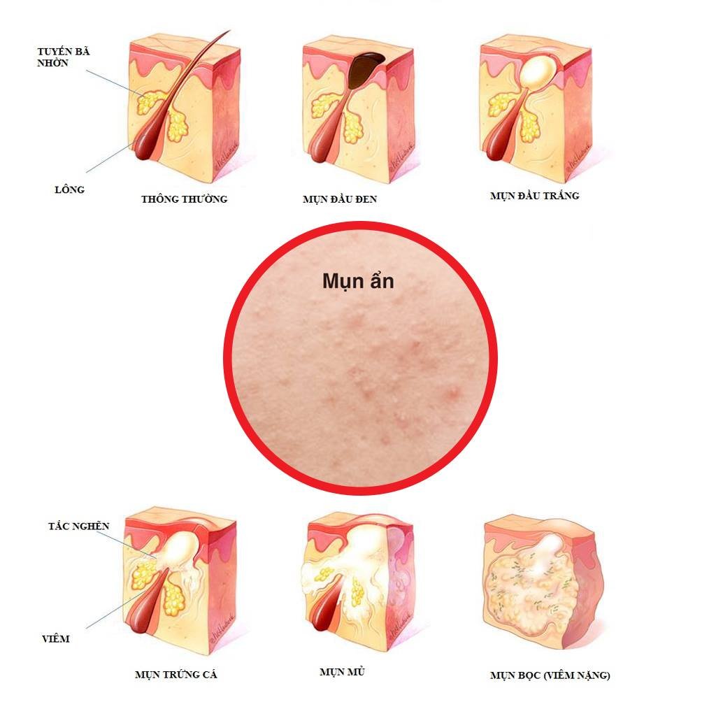 trị mụn tuổi dậy thì