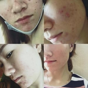 Điều trị mụn tận gốc - Bạn Dung