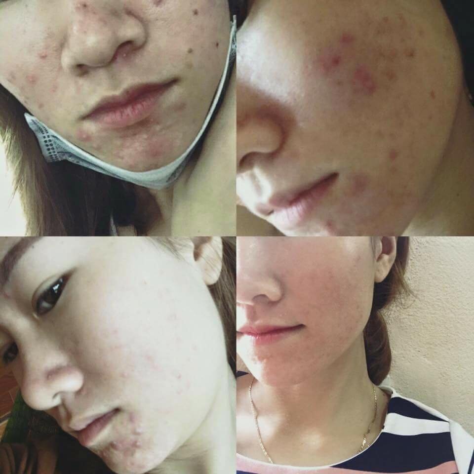 Điều trị mụn tận gốc - Bạn Dung