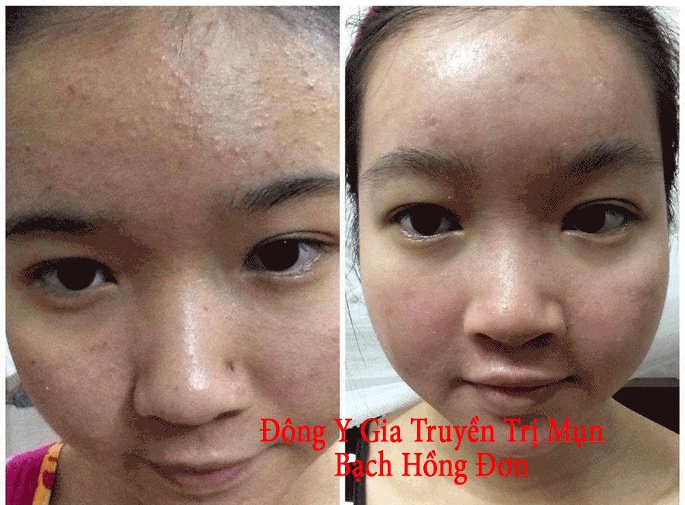Mặt Nạ – Bạch Hồng Đơn Cao Cấp