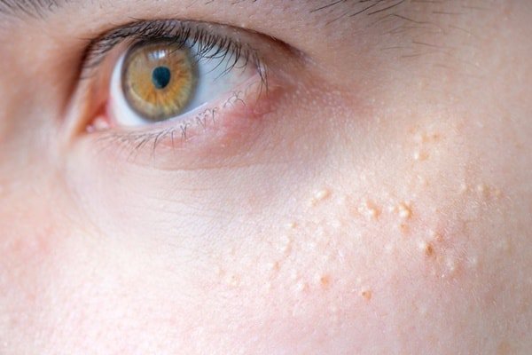 trị mụn trứng cá ở tuổi dậy thì