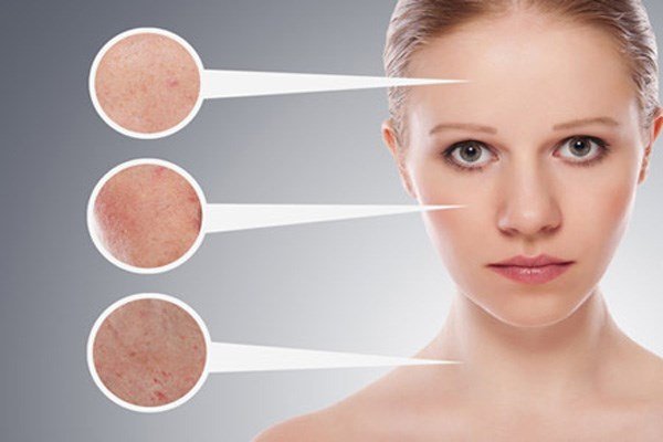 trị mụn tuổi dậy thì