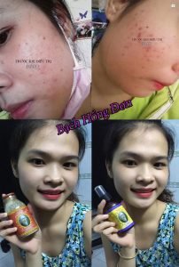 Trị mụn tận gốc do nhiễm độc hóa mỹ phẩm, nguồn nước sinh hoạt thay đổi ô nhiễm