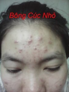 Mụn u nang, mụn viêm