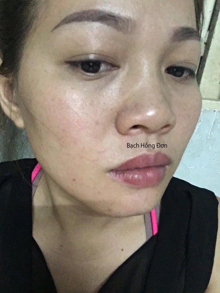 Chị Hồng Nhung ở Bình Dương trị tàn nhang lâu năm hiệu quả tối đa 1