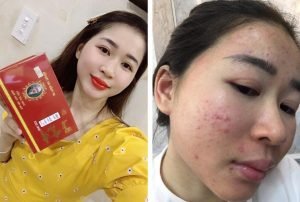 Bạn Hotgirl Tường Vi ở Quảng Ngãi điều trị mụn viêm, mụn ẩn, thâm mụn, rỗ hiệu quả tận gốc 5