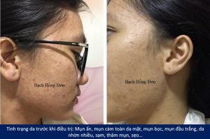 Em sinh viên Nhật Loan điều trị mụn viêm, mụn mủ, mụn đầu đen, mụn ẩn, rỗ, thâm, da sạm... hiệu quả tận gốc 3