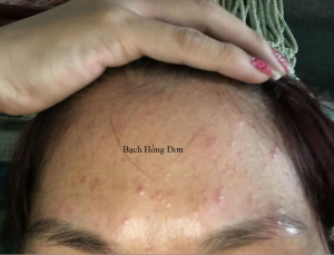 Da trước điều trị: Mụn viêm, mụn bọc, mụn ẩn, nhờn nhiều.