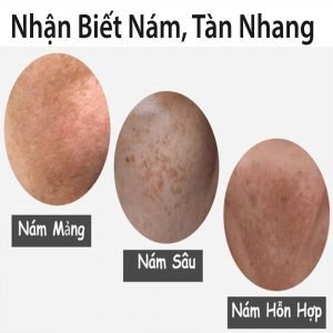 Định nghĩa về Nám, Tàn nhang? Nguyên nhân da bị Nám, Tàn nhang? 3