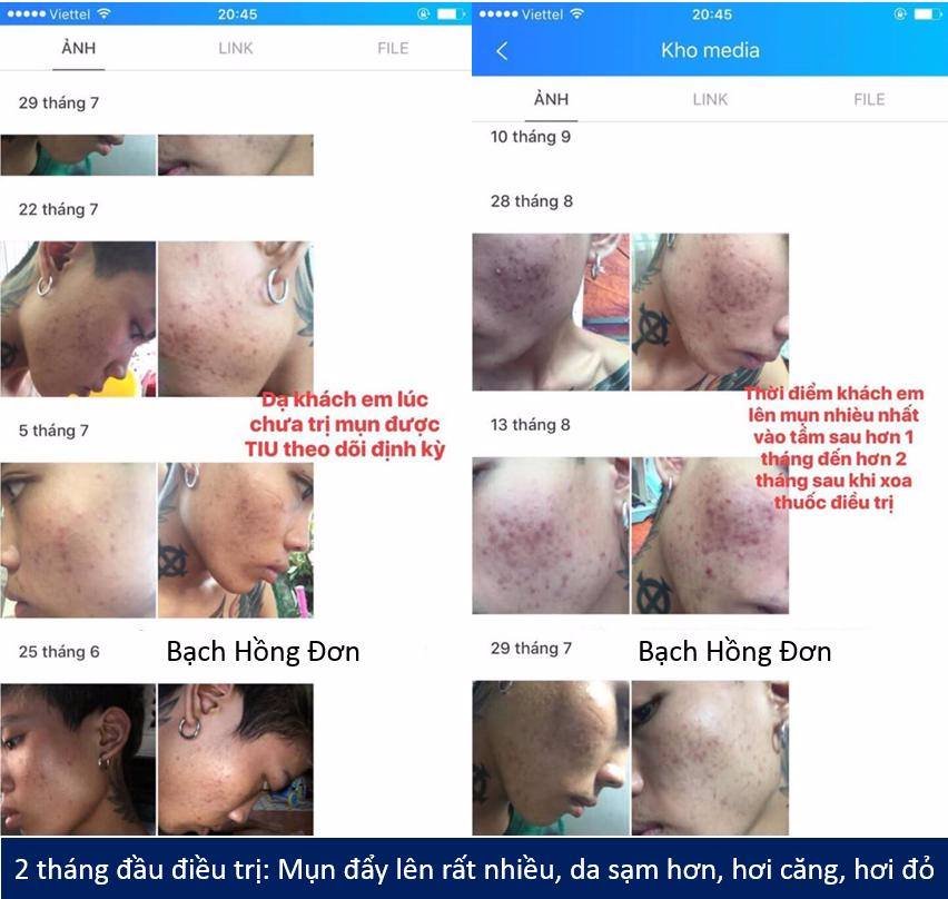 Da có hiện tượng nổi nhiều mụn hơn trong quá trình điều trị Mụn, tốt hay xấu? 1