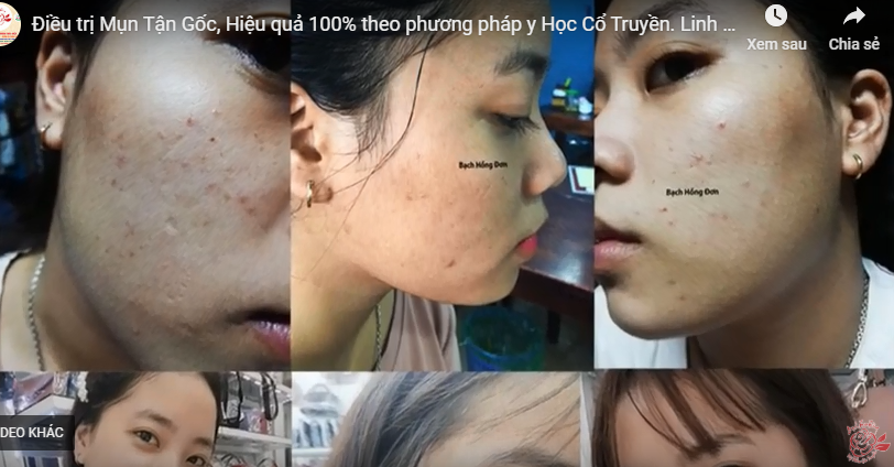 Linh Sunty điều trị hiệu quả tận gốc mụn ẩn, thâm, nám, sạm...
