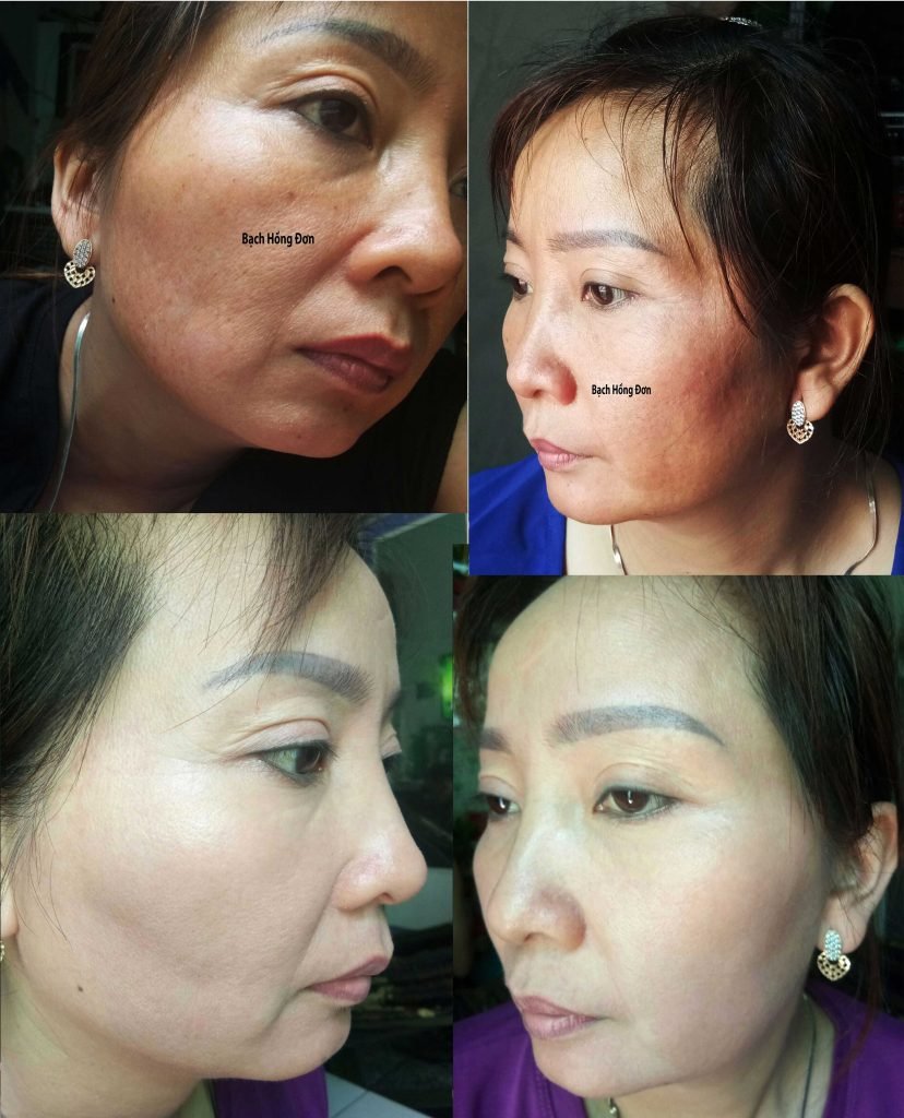 Bạch Hồng đơn Trị Nám Hường đinh